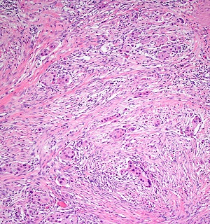 Bladder cancer cells