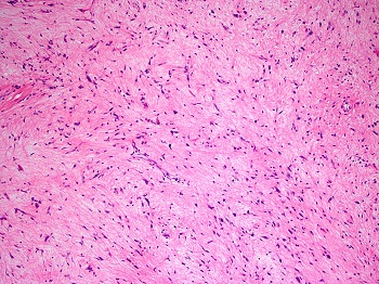 Sarcoma cells