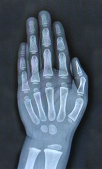 X-ray