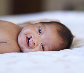 baby with cleft lip