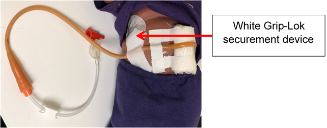 Malecot White Grip-Lok securement device