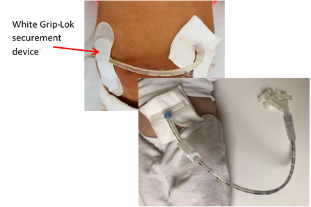 White Grip-Lok securement device