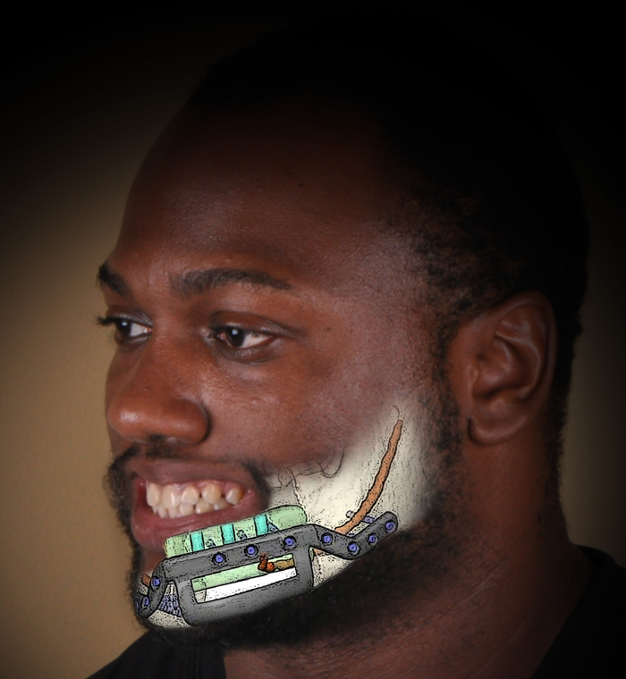 jaw reconstruction