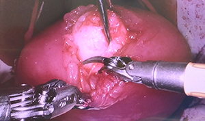 Bleeding Uterus for Simulation