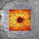 Retrograde degeneration of early visual pathways