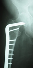 AO Blade plate in subtrochanteric fracture