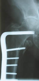 AO Blade plate in subtrochanteric fracture