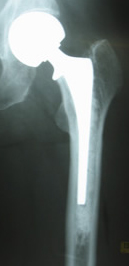 Hip Hemiarthroplasty