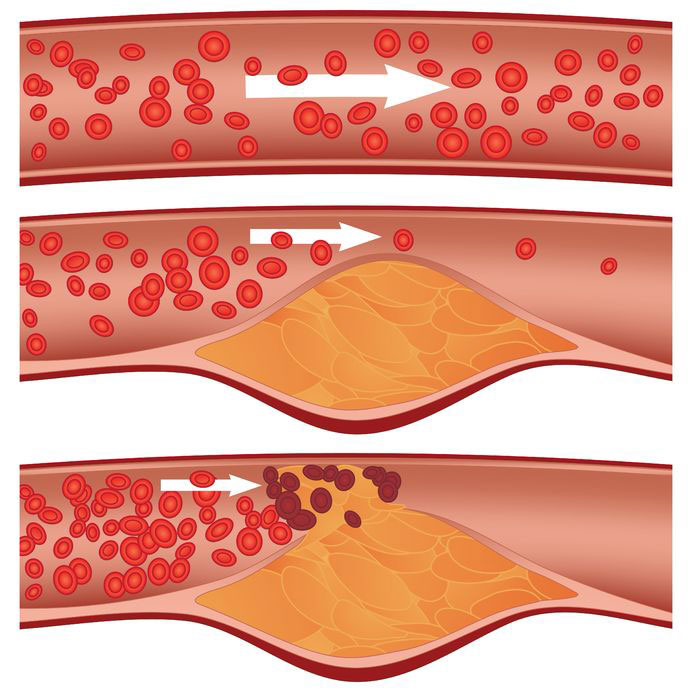 Cholesterol