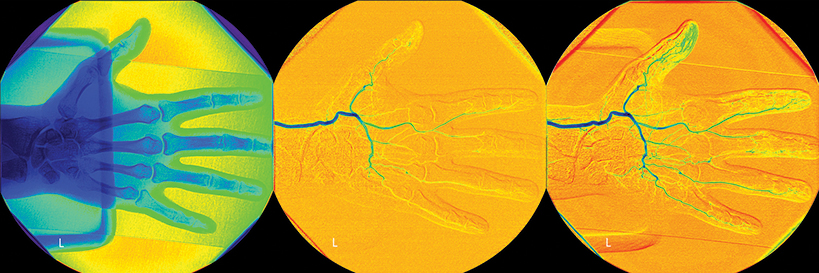 hand and blood vessels