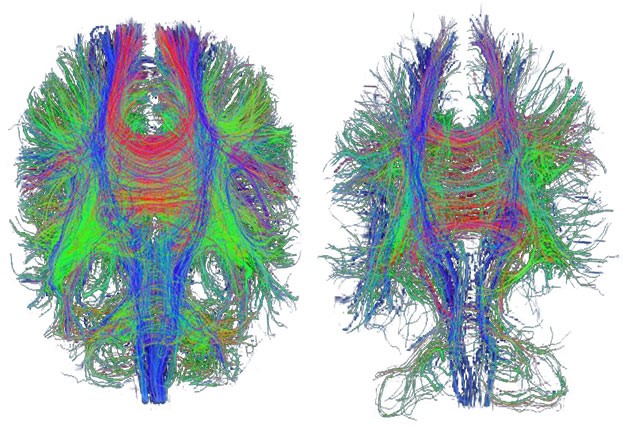 DTI brain scan