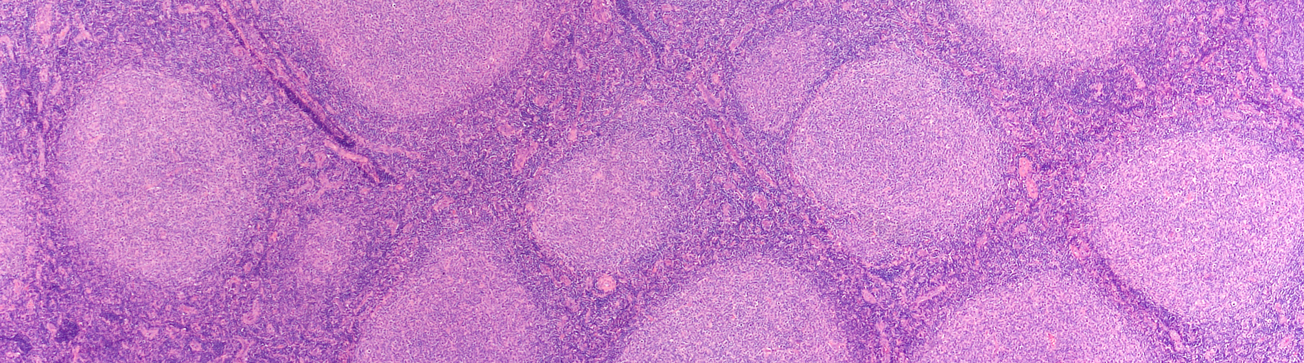 lymphoma