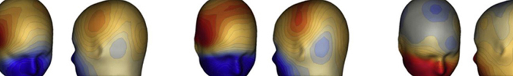 Lysosomal Storage Disorders – Niemann-Pick