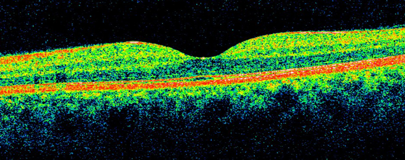 2 eye scan macular cube imaging