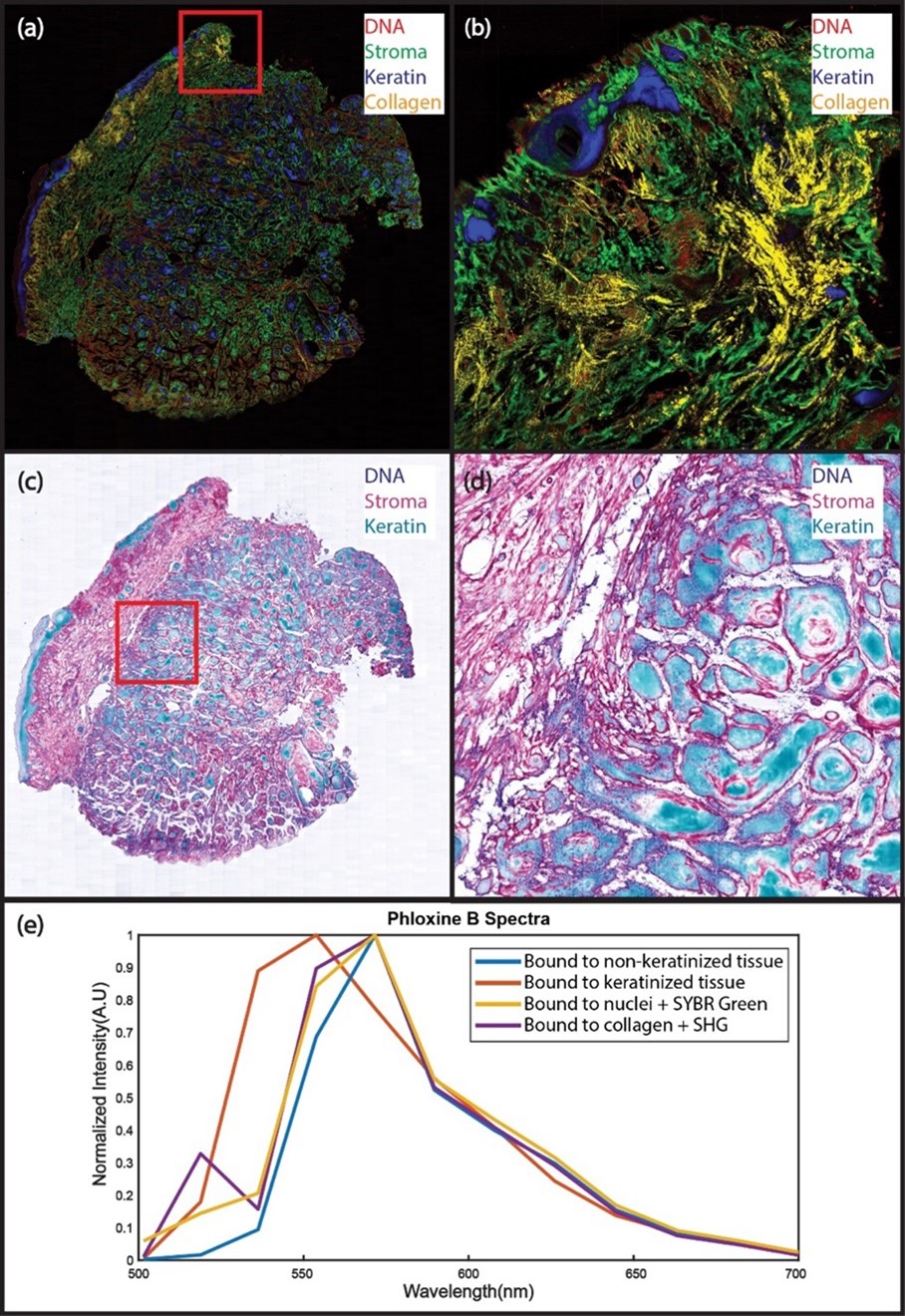 Human surgical margin positive for squamous cell carcinoma labeled with SYBR Green (DNA) and Phloxine B (protein and keratin) imaged at 50 MP/s with hyperPICASSO unmixing.  (a): Spectrally unmixed mosaic image with DNA (red), the non-keratin bound PhB (green), keratin-bound PhB (blue), and collagen (Yellow). (b): The enlarged region in B shows keratin-rich regions, such as the epidermis and hair follicles, as well as hallmarks of squamous cell carcinoma, such as keratin pearls. Strong SHG single is from dense connective tissue forming due to a previous biopsy. (c): The mosaic in (a) is rendered as a virtual trichrome stain using the virtual transillumination algorithm  (d): The enlarged region shows PhB bound to different tissue types.  (e): Spectra from regions in A - D showing the change of PhB emission upon binding to keratinized tissue(orange vs blue), combining emission with SGr on nuclei with additional emission in green (yellow vs. blue), and combining emission on collagens with additional SHG peak(purple vs. blue). Imaging time for the 220 mm2 slide was less than 2 minutes.