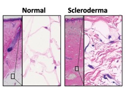 Normal vs Scleroderma