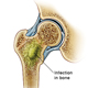 Impact of obesity and type 2 diabetes on <em>Staph aureus</em> bone infection severity