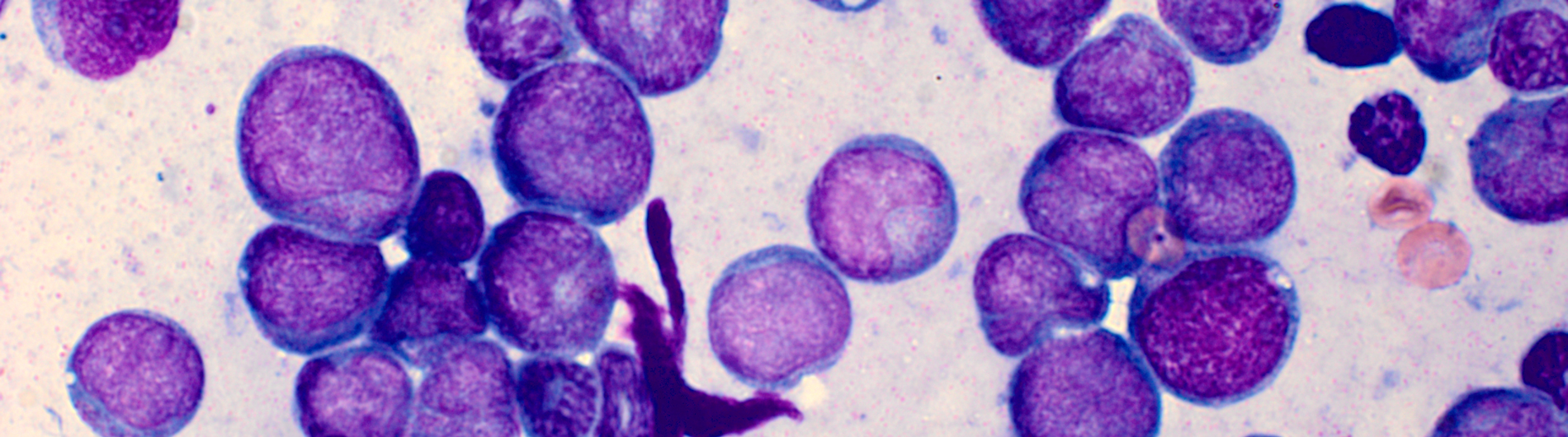 acute myeloid leukemia