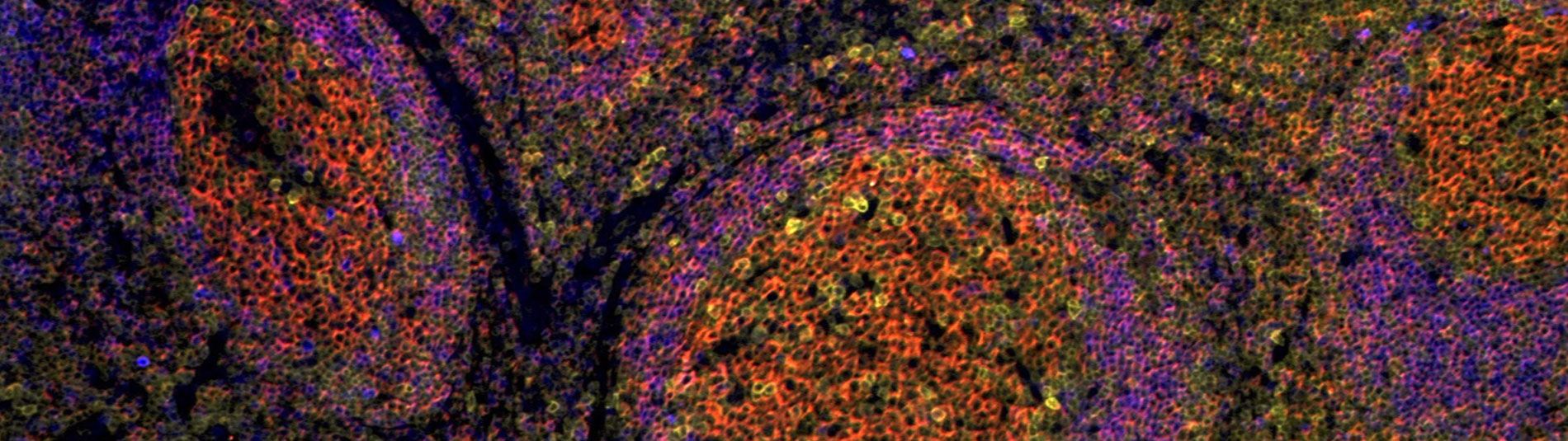 B cells in discoid lupus erythematosus