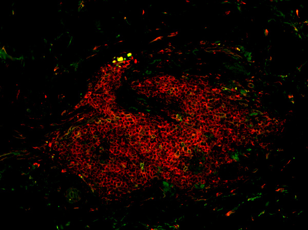 B cells in discoid lupus