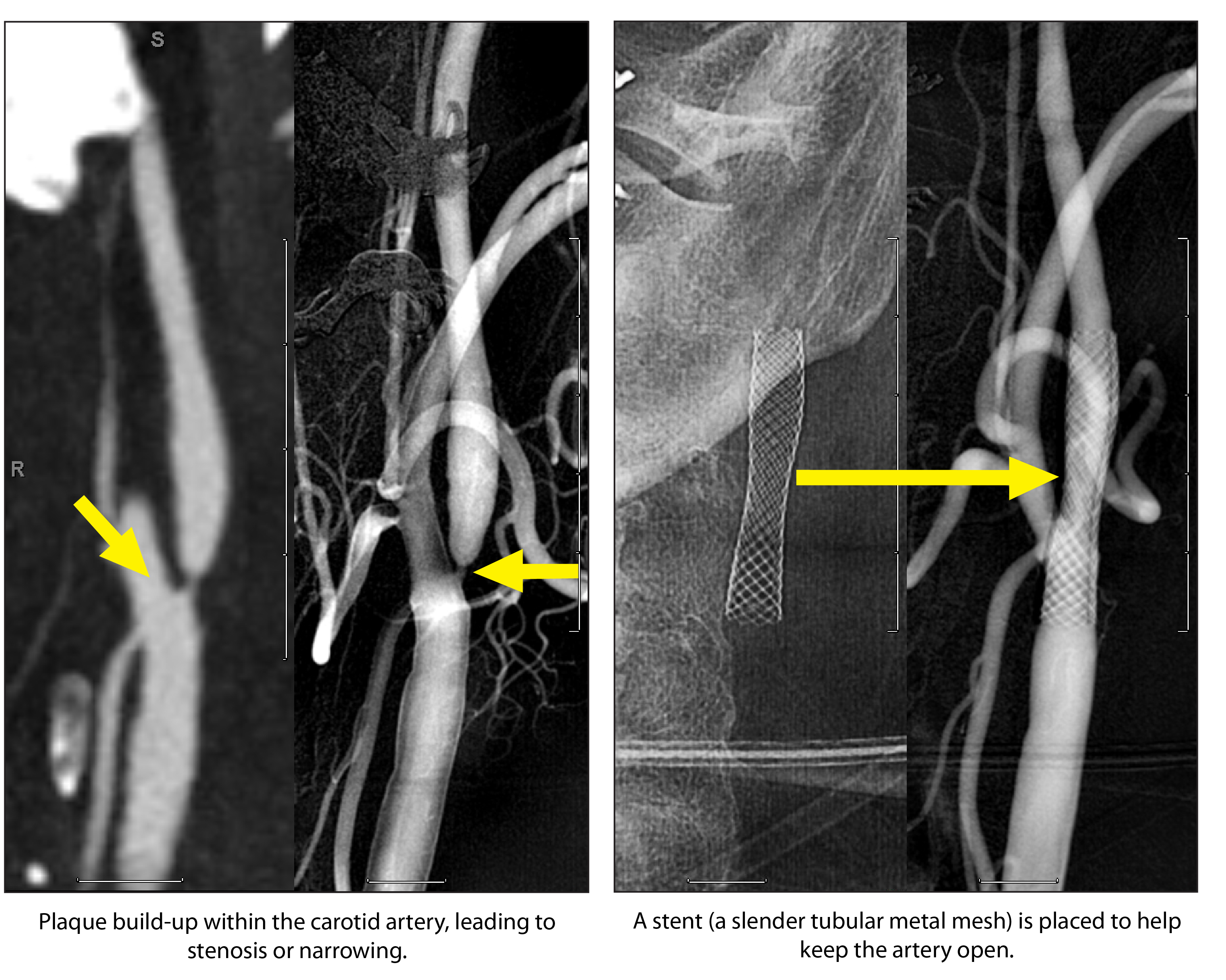 STENT CA