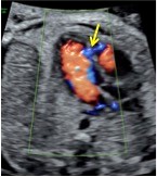 Ventricular Septal Defect Image