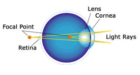 astigmatic eye