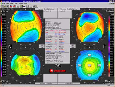 Orbscan corneal mapping system