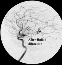 After vasospasm