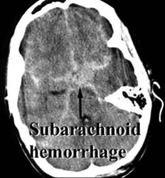 Subarachnoid Hemorrhage