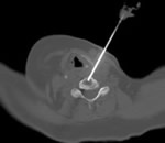 Cervical Biopsy of the Spine using a 13G Bone Biopsy Needle