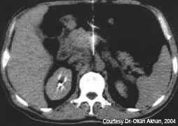 Celiac Ganglion Block