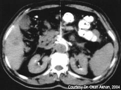 Celiac Ganglion Block