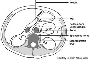 Celiac Ganglion Block