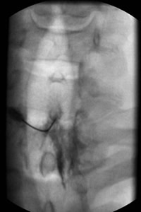 Cervical Epidural Steroid Injection