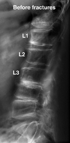 Compression Fractures