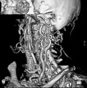 CT Angiogram of the Neck