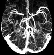 CT Angiogram of the Skull