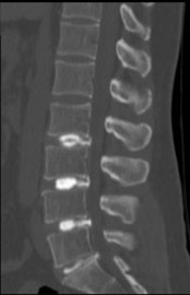 Side view, lumbar discogram