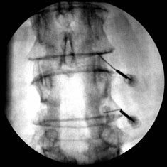 SI and Facet Joint Injection