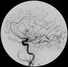 Carotid Angiogram