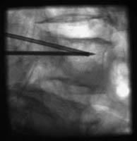 Vertebroplasty Figure 4