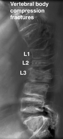 Compression Fractures