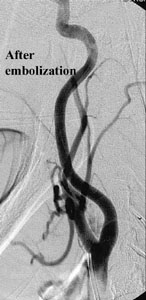 After Embolization