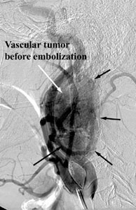 Tumor before Embolization