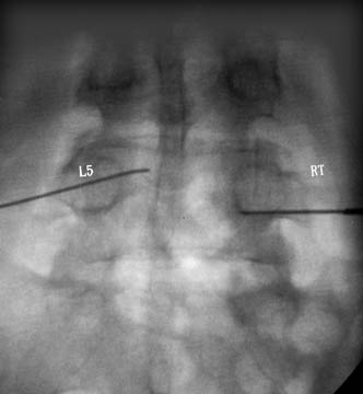 Superior Hypogastric Block