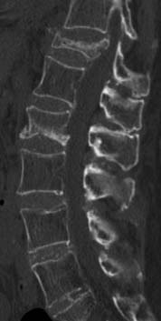 Post-kyphoplasty vertabrae