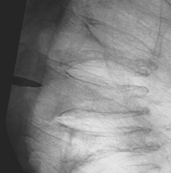 Before reduction of vertebral body compression fracture