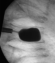 After reduction of vertebral body compression fracture