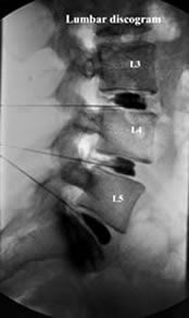 Lumbar discogram of 1.3, 1.4, 1.5